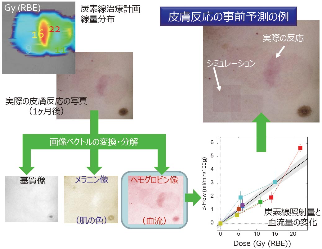 放射線治療による皮膚反応の評価と予測システム