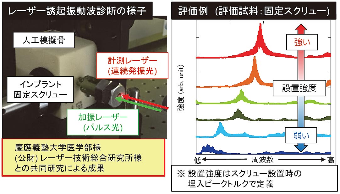 レーザー誘起振動波診断を用いたインプラント設置強度の定量評価