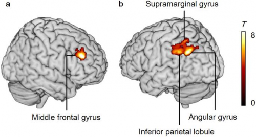 Brain activity of subjective fadedness (a, b) was associated with striatal dopamine D2 receptor availabilityの画像