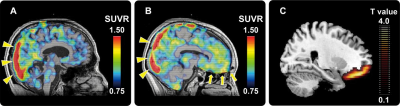 photo of Tau steal the motivation in Alzheimer's disease