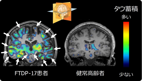 代表的なFtdp-17患者におけるタウ蓄積を表す