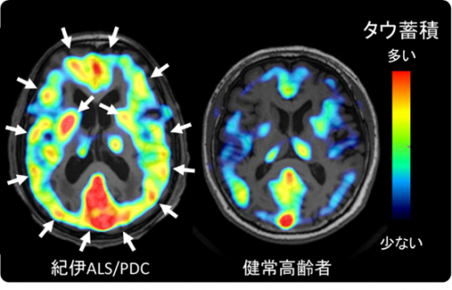 代表的な紀伊ALS/PDC患者におけるタウ蓄積を示した図