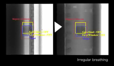 X線透視による呼吸同期動画へのリンク