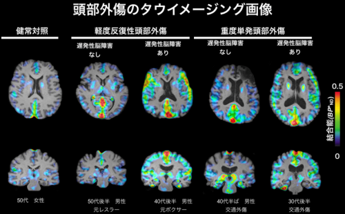 代表的な頭部外傷患者におけるタウ蓄積