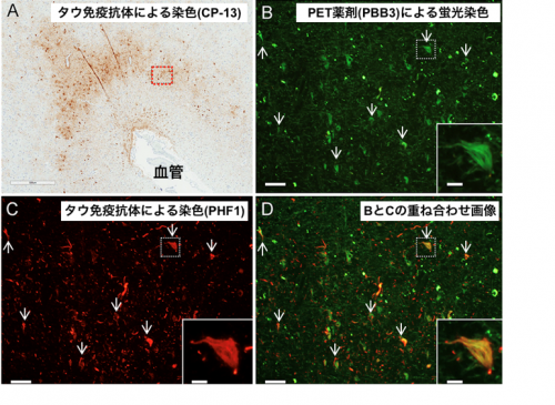 死後脳におけるタウ蓄積とPBB3集積