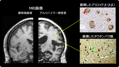 アルツハイマー病における脳の変化の画像