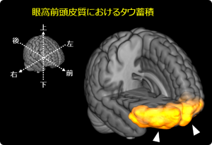 意欲低下が強いアルツハイマー病患者におけるタウ蓄積の画像