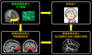 アルツハイマー病におけるタウ蓄積ならびに神経障害と意欲低下の関連の画像