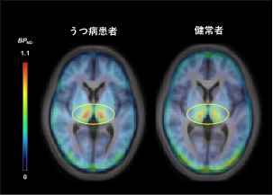 うつ病患者と健常者の脳内NATのPET画像