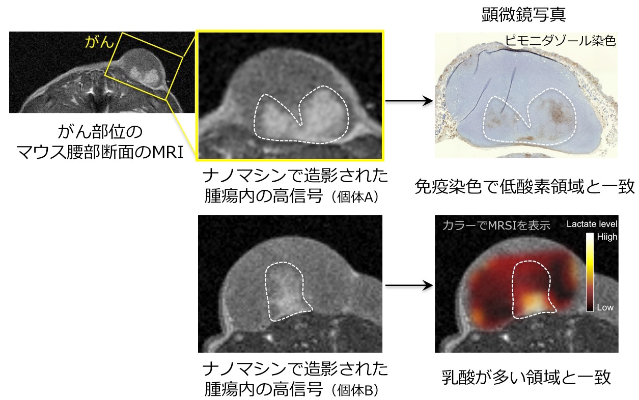 図2.ナノマシン造影剤により、がんの検出すると同時にがん内部の構造を描出