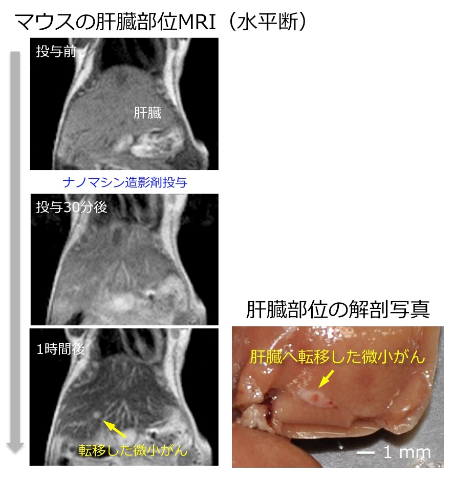 図4.ナノマシン造影剤により微小な転移がんを描出