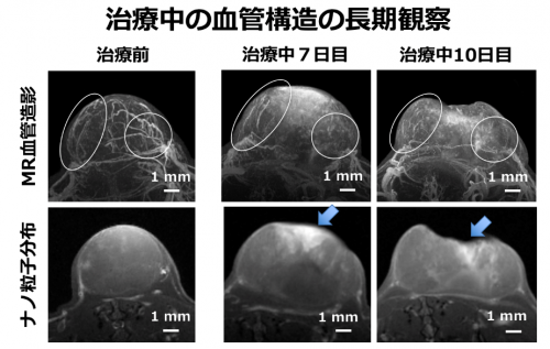 治療中のがんの血管構造の変化とナノ粒子の分布の画像