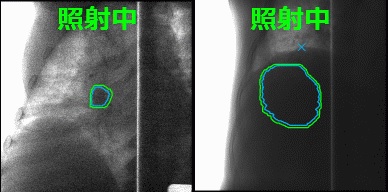 重粒子線呼吸同期照射のイメージ図