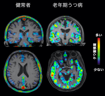 代表的な老年期うつ病におけるタウ蓄積