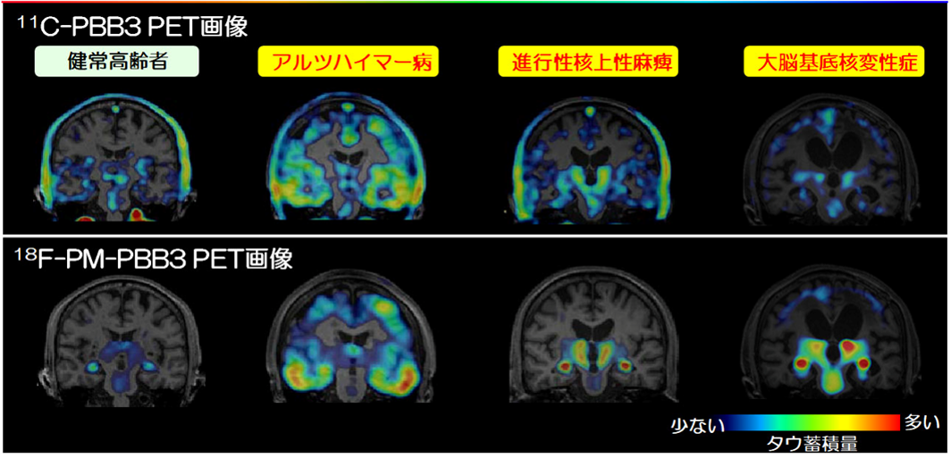  11C-PBB3から18F-PM-PBB3への進化