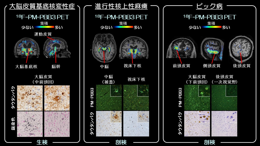 前頭側頭葉変性症患者におけるPET画像、病理所見との関連