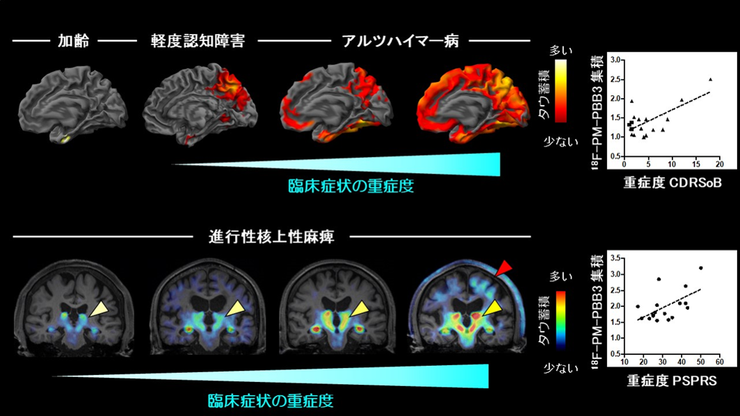 アルツハイマー病・進行性核上性麻痺患者におけるタウの分布と重症度との関連