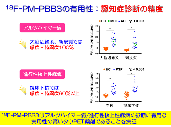 18F-PM-PBB3はアルツハイマー病/進行性核上性麻痺を高い感度・特異度で健常者と区別可能
