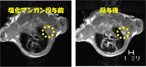 塩化マンガン造影ＭＲＩで検出した微小中皮腫