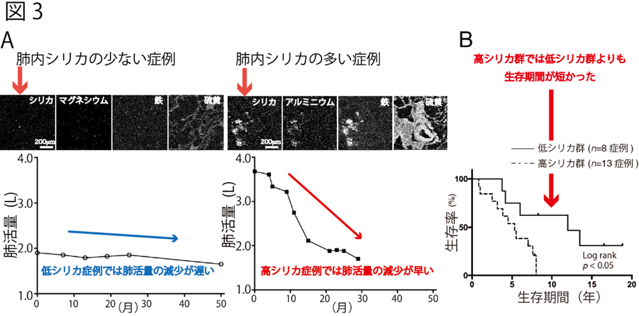 つまり肺内のシリカの量が多い患者さんは、肺線維症の進行が早いことが明らかになりました(図3A)。そして、肺内のシリカの量の多い肺線維症の方は、少ない肺線維症の方に比べて生存期間がより短くなっていることもわかりました。