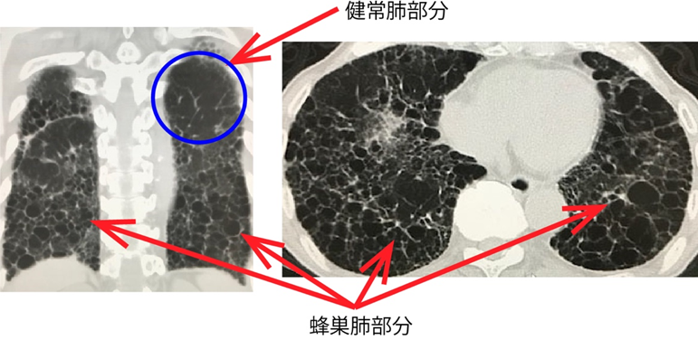 蜂巣肺の変化を起こす特発性肺線維症