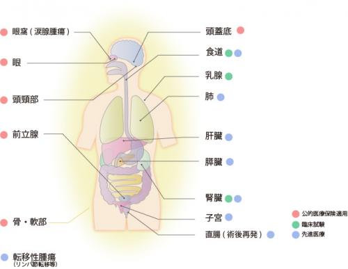 重粒子線治療の適応疾患