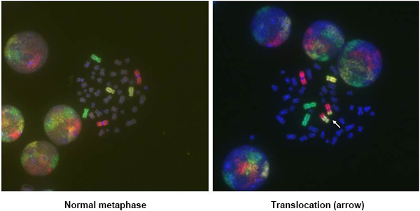  Chromosomal rearrangements detected by 3-color FISH photo1