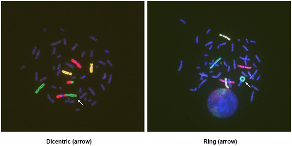Chromosomal rearrangements detected by 3-color FISH photo2