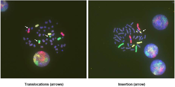 Chromosomal rearrangements detected by 3-color FISH photo3