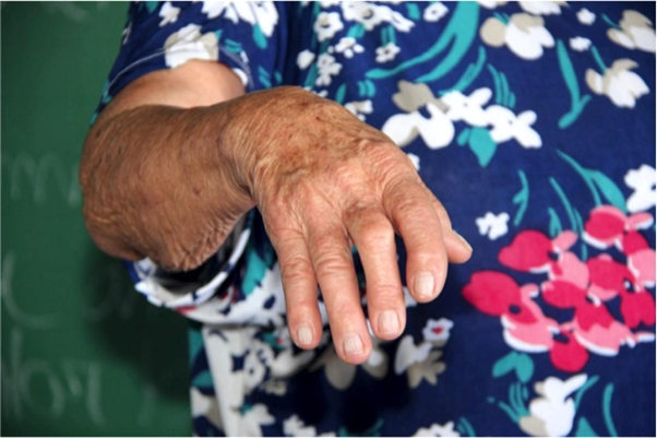 Rheumatoid Arthritis (CC BY-NC 2.0 Leides Moura).