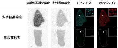 図２　多系統萎縮症患者と健常高齢者における死後脳を用いた検討