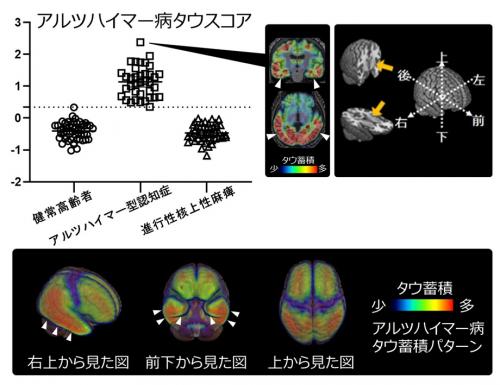 アルツハイマー型タウスコア