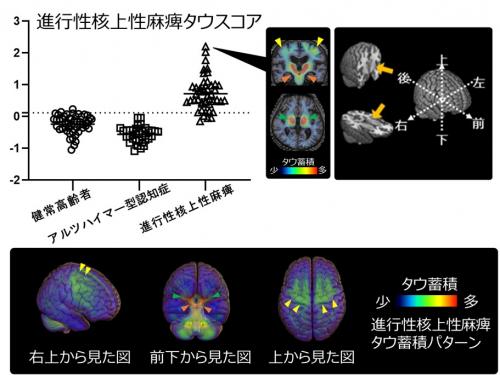 進行性核上性麻痺タウスコア