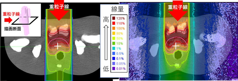 従来の線量計算方法(左)と本システム(右)で評価した人体模擬ファントム内の線量分布の比較例。