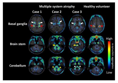 Title: α-synuclein aggregates as seen on a PET scan in patients with MSA and a healthy control