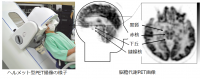 ヘルメット型PET装置と脳のPET画像