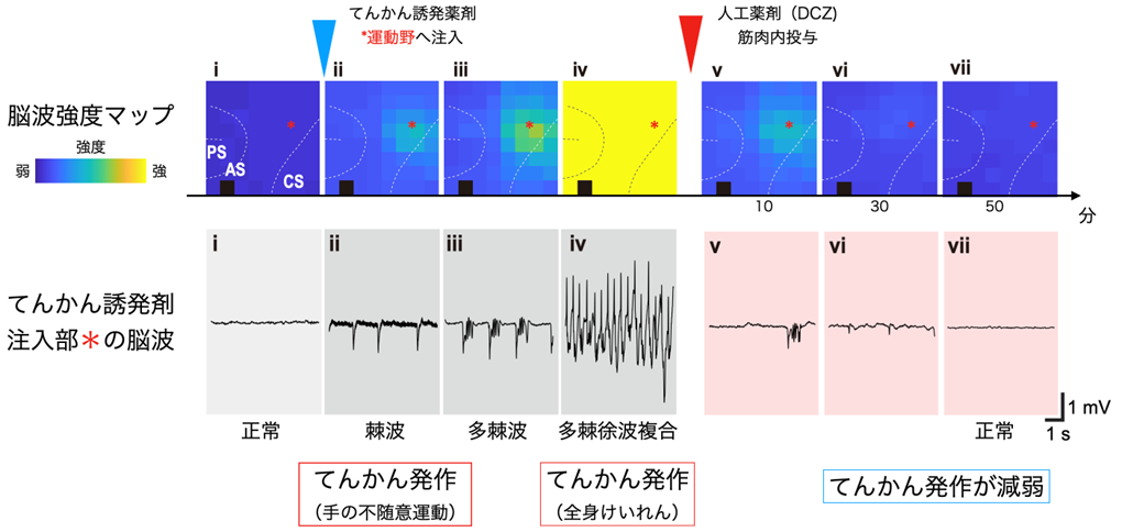 脳波によるてんかんのモニタと「オンデマンド治療」の効果の一例 