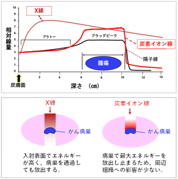 X線と炭素イオン線の線量分布の比較