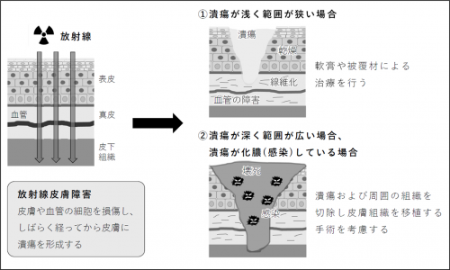 放射線皮膚障害とその治療の説明図