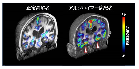 PBB3を投与後に撮影した脳PET画像