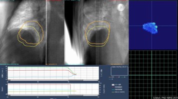 Screen capture for Markerless motion tracking treatment using X-ray fluoroscopy.