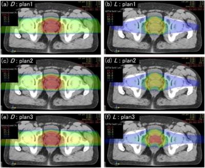 Dose distribution chart of multi-ion radiotherapy for prostate cancer. 