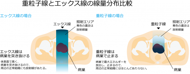 エックス線と重粒子線の線量分布比較