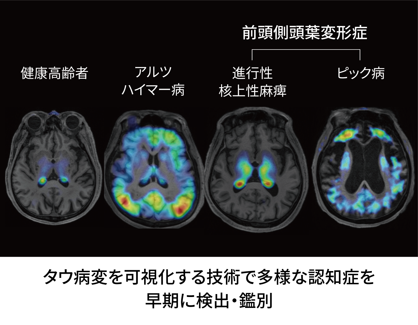 タウ病変検出