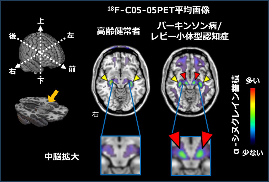 健常8人とパーキンソン病8人/レビー小体型認知症2人の平均PET画像