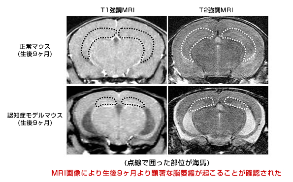 加齢に伴う海馬の委縮