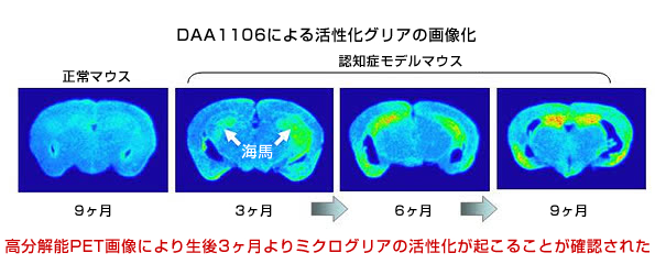 活性化ミクログリアトレーサーの結合増加