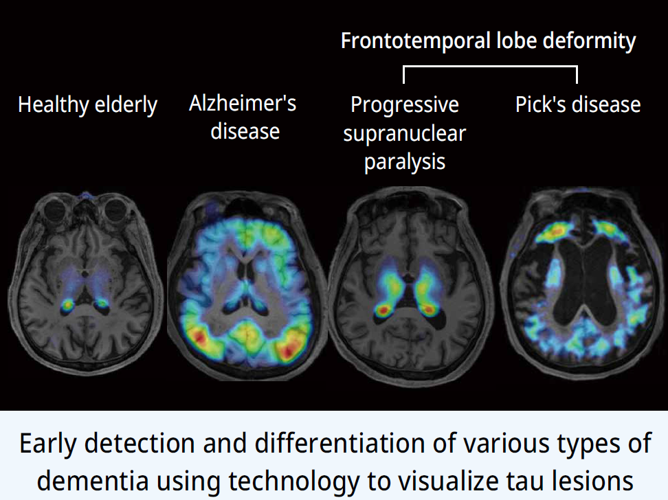 Early detection and differentiation of various types of dementia using technology to visualize tau lesions