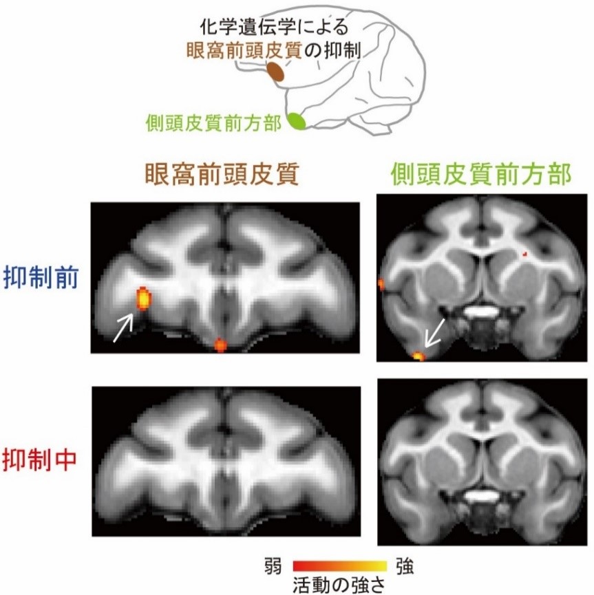 眼窩前頭皮質の抑制による、側頭皮質前方部の遠隔抑制