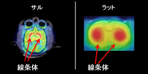 [11C]MNPA投与によるドーパミンD2受容体のPET画像とMRI画像の重ね合わせ